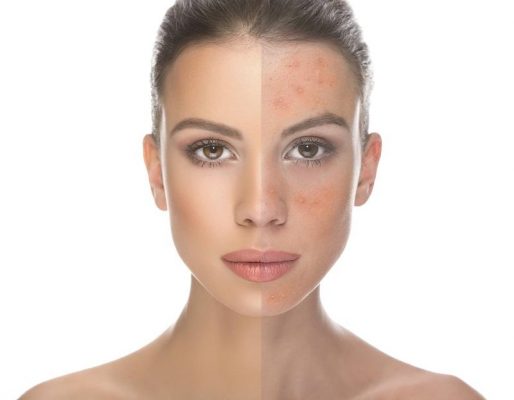 rosacea kezelese